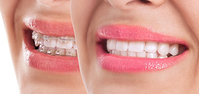 A close-up of a smiling person with pink lipstick and teeth, showcasing a dental implant or tooth replacement.