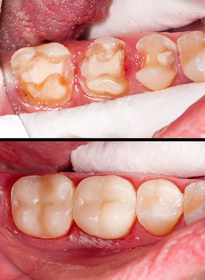 The image shows a close-up of a person s mouth with teeth in various states of decay and discoloration, with some teeth showing signs of cavities and wear.