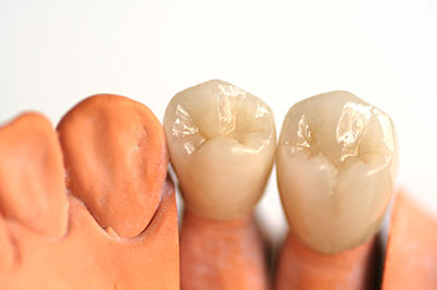 Two artificial teeth with a clear crown and gumline, set against a white background.