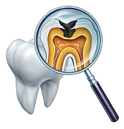 An illustration of a dental model with an open mouth, showcasing the internal tooth structure and gumline, viewed through a magnifying glass.