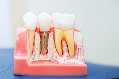 A close-up of a dental model with artificial teeth and gums, showcasing the process of dental implantation.