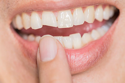 The image shows a close-up of a person s smiling mouth with visible teeth and lips, along with their hand holding what appears to be a dental implant or restoration.