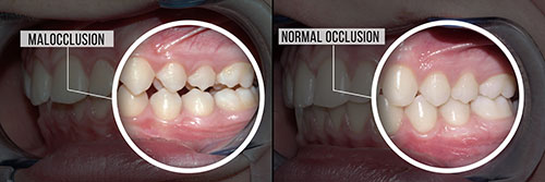 The image shows a side-by-side comparison of a mouth with teeth and gums, and the same mouth after a dental procedure.