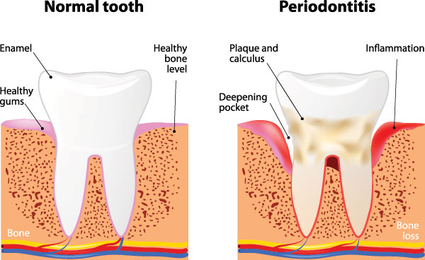 The image displays a diagrammatic representation of the normal and periodontal stages of tooth decay, illustrating the progression from healthy enamel to advanced bone loss.