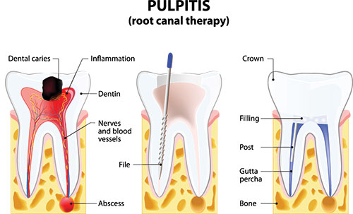 The image is a medical illustration showing the process of root canal therapy, with labeled parts including a tooth with a cavity, dental instruments like a drill and file, and anatomical depiction of the pulp chamber and nerve.