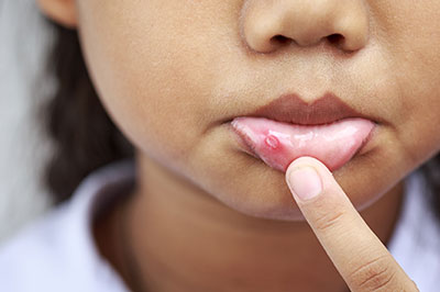 The image shows a close-up of a person s face with a finger pointing to an area on the skin, which appears to be affected by acne or a similar skin condition.