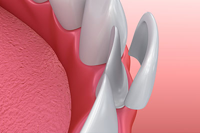 The image shows a close-up of a dental implant with a metal abutment, set against a pink background that resembles gum tissue.