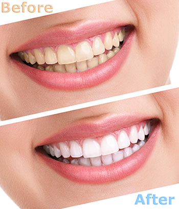 The image showcases a woman s smile transformation, with the  before  picture on the left and the  after  picture on the right, both featuring her teeth.